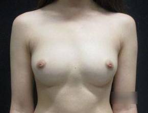 Breast Augmentation Case 46 Before