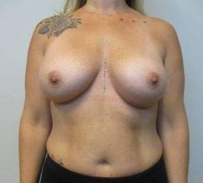 Breast Augmentation Case 51 After