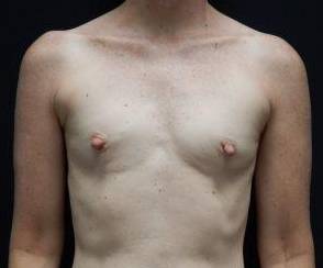 Breast Augmentation Case 55 Before