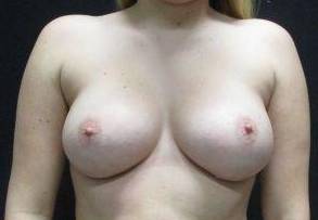 Breast Augmentation Case 56 After