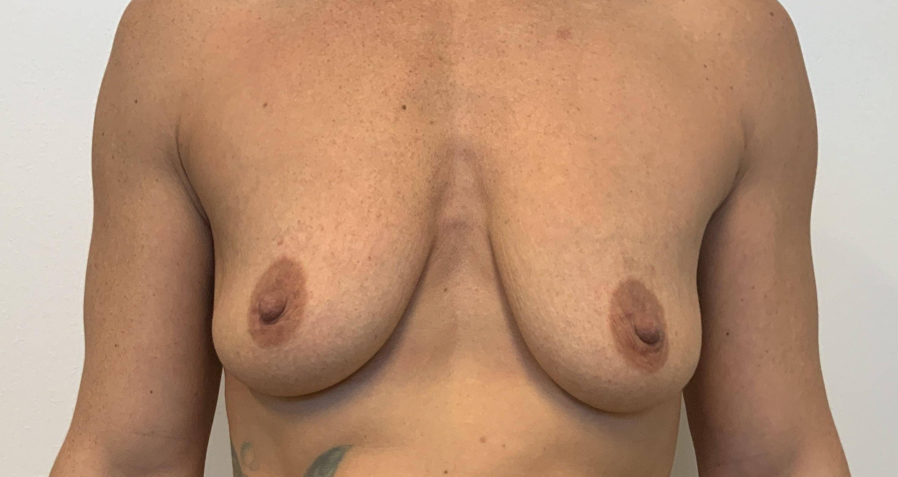 37-year-old female, breast augmentation 1 Before