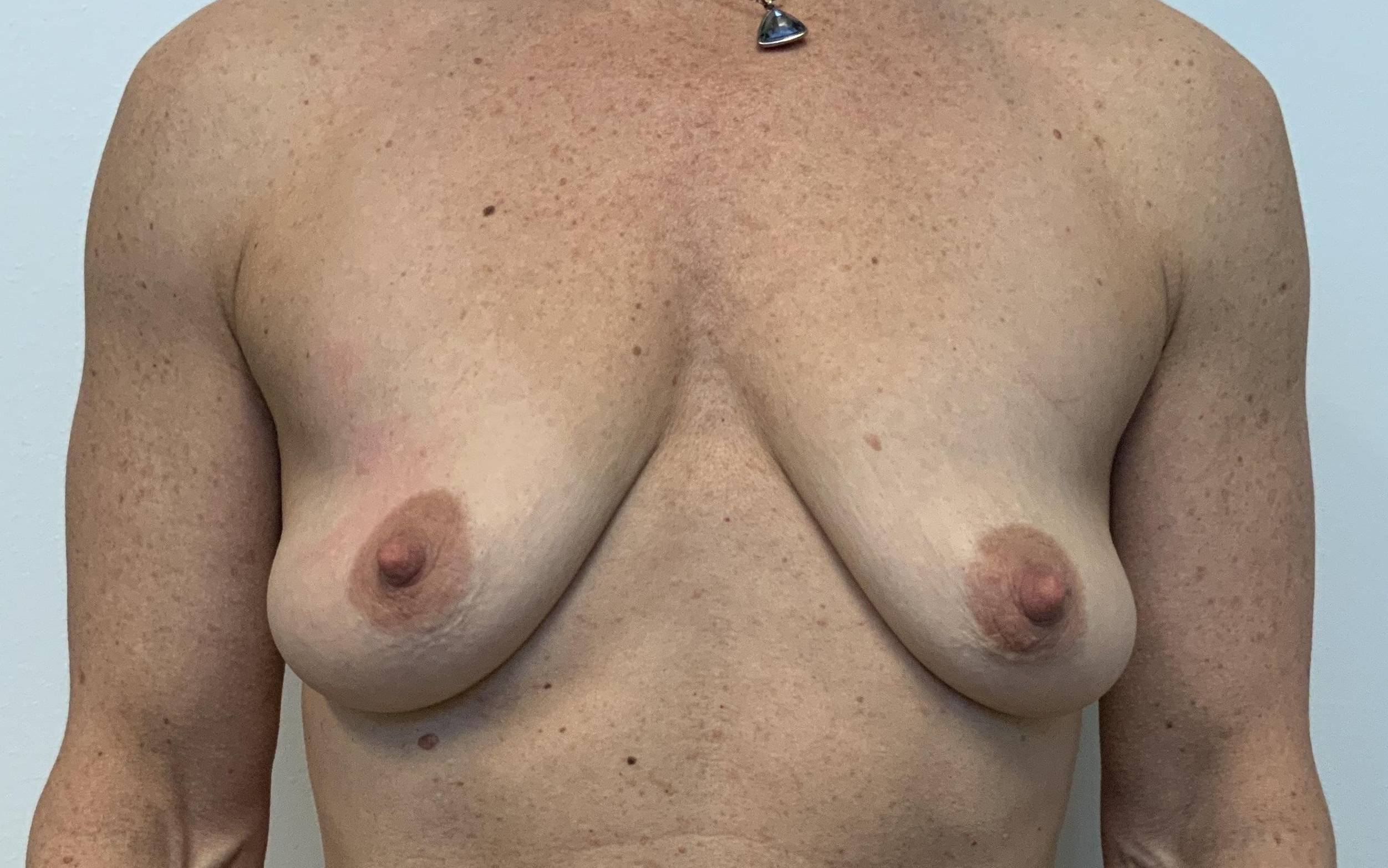 55-year-old female, breast augmentation, mastopexy Before