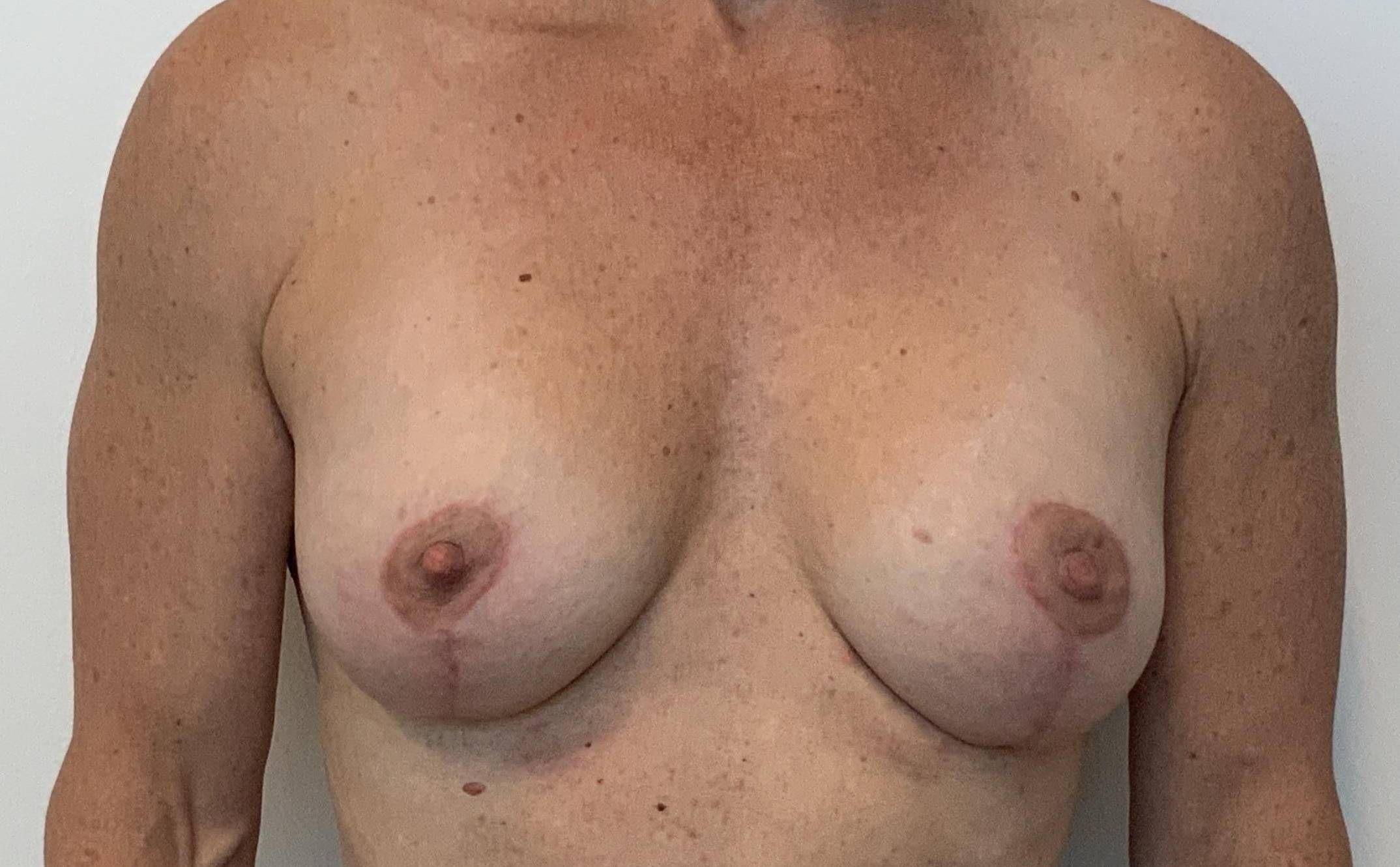 55-year-old female, breast augmentation, mastopexy After