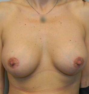 Breast Augmentation Case 10 After