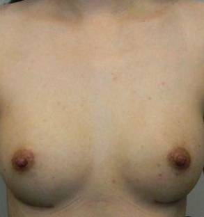 Breast Augmentation Case 11 After