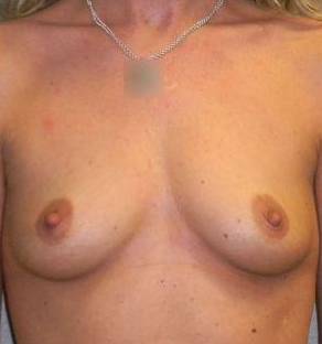 Breast Augmentation Case 12 Before