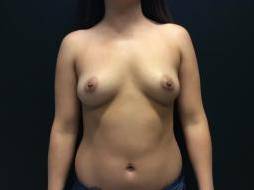 Breast Augmentation Case 14 Before