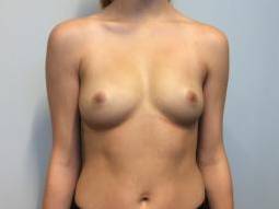 Breast Augmentation Case 15 Before