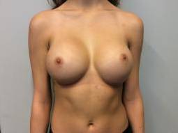 Breast Augmentation Case 15 After