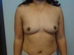 Breast Augmentation Case 16 Before