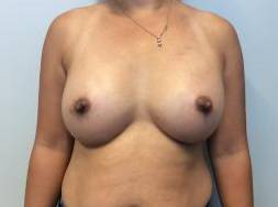 Breast Augmentation Case 16 After