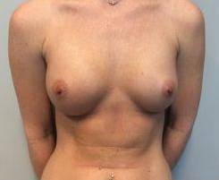 Breast Augmentation Case 18 After