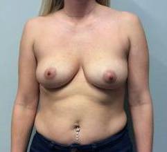 Breast Augmentation Case 20 Before