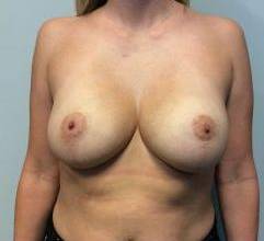 Breast Augmentation Case 20 After