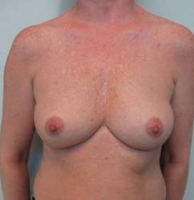 Breast Augmentation Case 24 Before