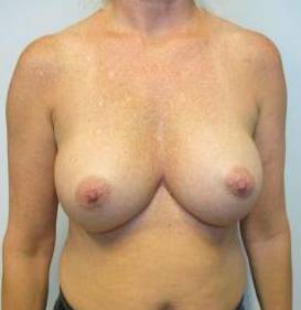 Breast Augmentation Case 24 After