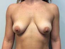 Breast Augmentation Case 27 Before