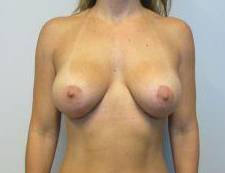 Breast Augmentation Case 27 After