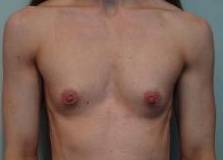 Breast Augmentation Case 28 Before