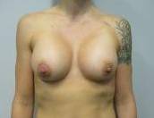 Breast Augmentation Case 29 After