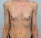 Breast Augmentation Case 31 Before