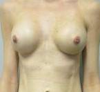 Breast Augmentation Case 31 After