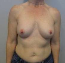 Breast Augmentation Case 34 After