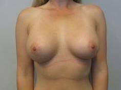 Breast Augmentation Case 37 After