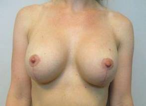 Breast Augmentation Case 39 After