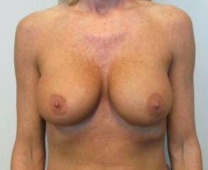 Breast Augmentation Case 40 Before