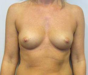 Breast Augmentation Case 41 Before