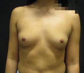 Breast Augmentation Case 44 Before