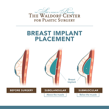 Breast Implants, Portland, OR