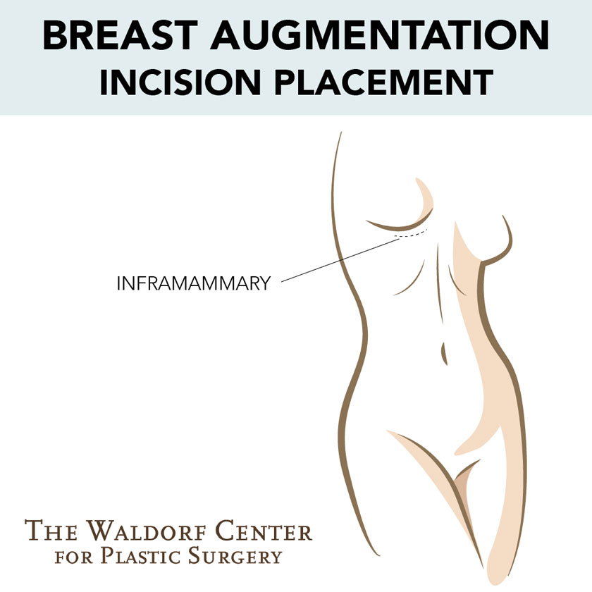 Breast Augmentation Near Me - Breast Augmentation Surgery