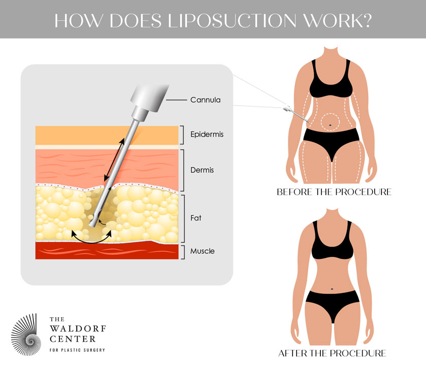 Full Body Liposuction, Abdomen Liposuction Surgery