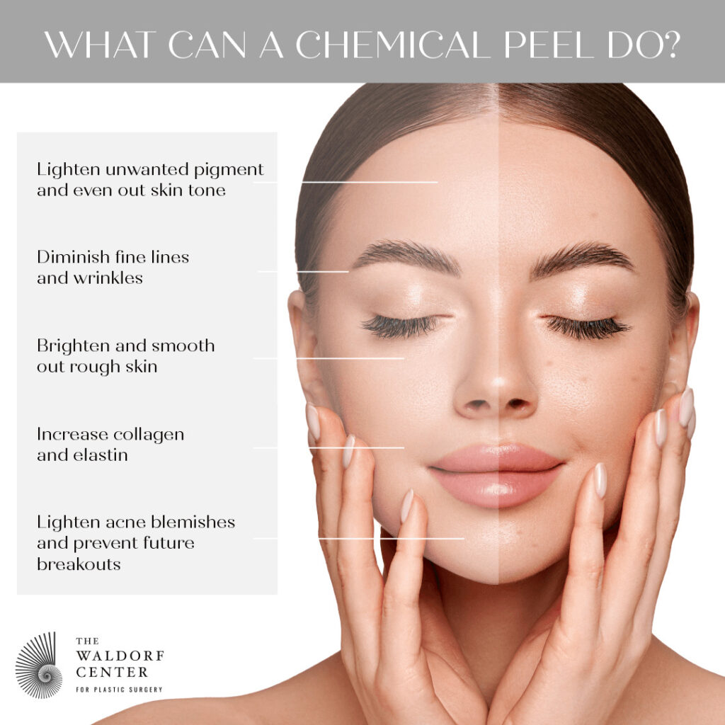 Chemical Peels | Portland, Oregon | Waldorf Center for Plastic Surgery