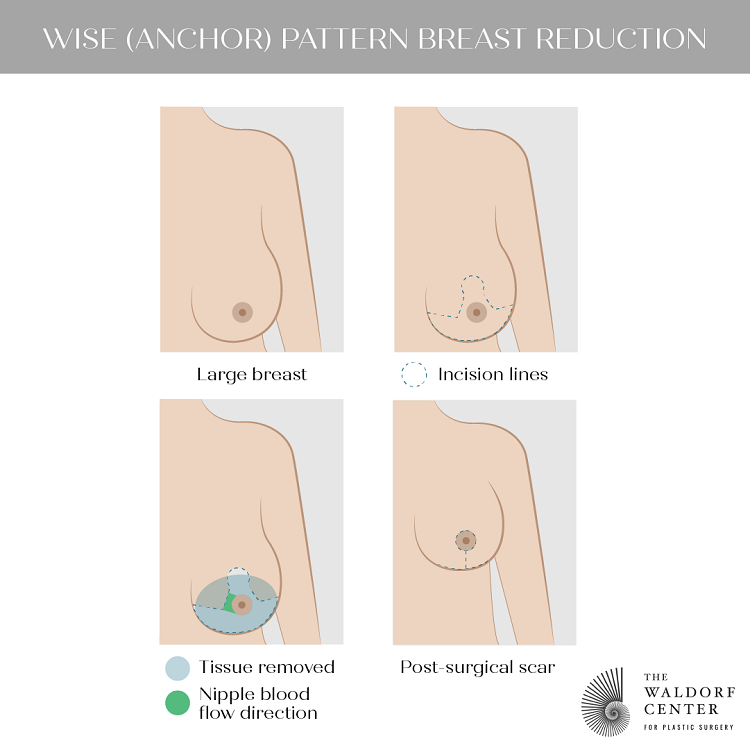 Breast Reduction - Elite Plastic & Reconstructive Surgery